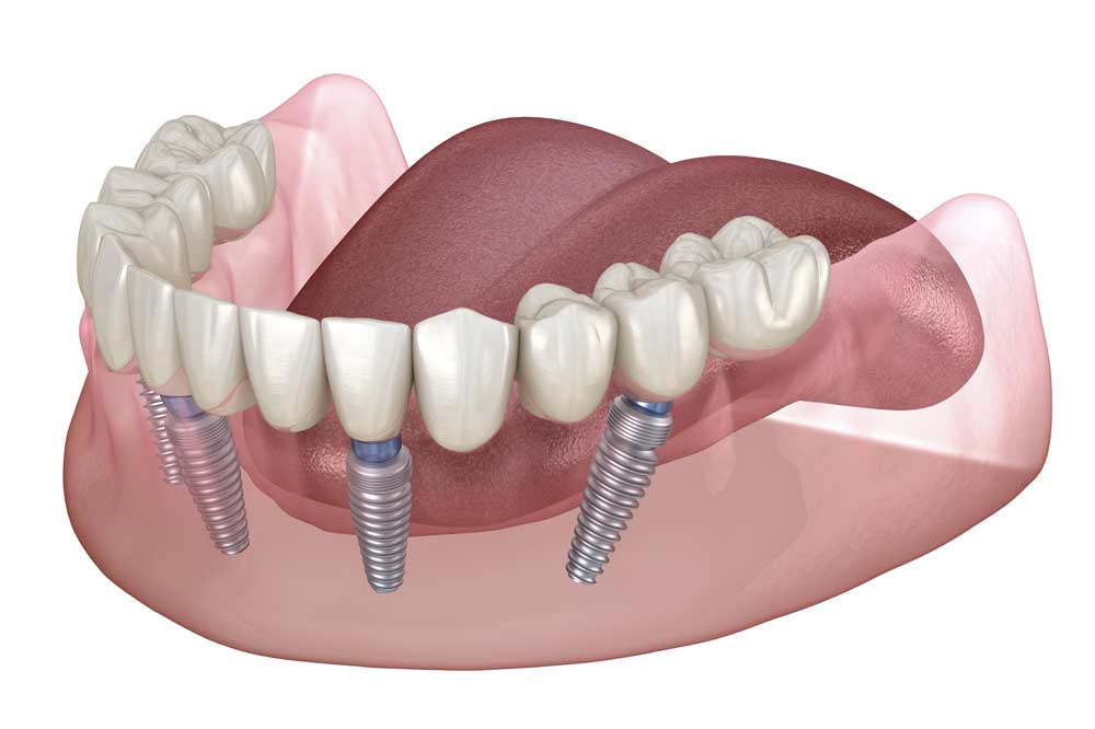 Implant dentures all on 4