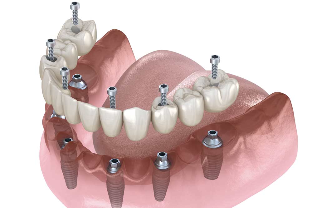 Implant dentures